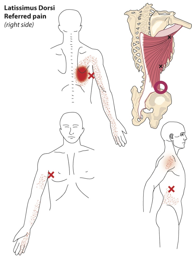 Finding Trigger Points - Latissimus Dorsi